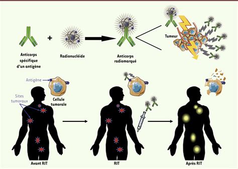 Radio Immunothérapie Alpha Principes Et Intérêts En Immunité