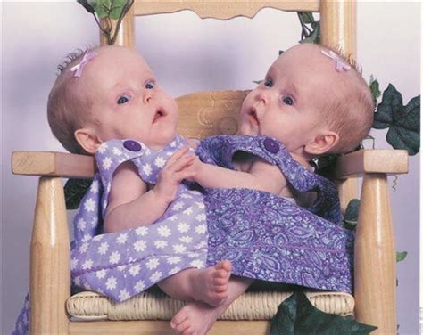 Conjoined Twins Kendra And Maliyah Separated By Surgery Are Thriving