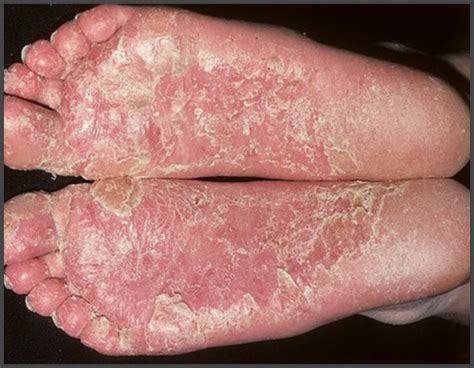Psoriasis On Feet Pictures Psoriasis Expert