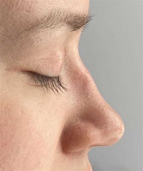 Plastic Surgery Case Study The Long Nose Rhinoplasty With Tip