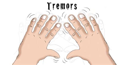 Hand tremors are unintentional rhythmic movements of the hand that occur either at rest or with motion. Tremor Causes, Symptoms, Diagnosis and Treatment - Natural ...