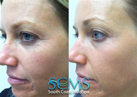 Laser Resurfacing Wrinkle Removal Start Now And Be Glowing For The New