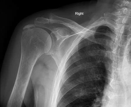 Supraspinatus Calcific Tendinitis Radiology Case Radiopaedia Org