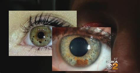 New Study Looks At Possible Relationship Between Eye Freckles And