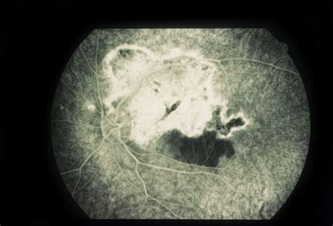 Paracentral Blind Spot And Scotoma Retina Image Bank