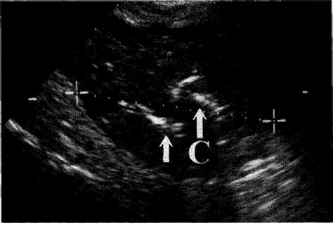 figure 3 from transvaginal ultrasound guided aspiration of pelvic abscesses semantic scholar