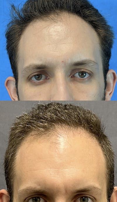 Patient 141159478 Artas® Hair Restoration Before And After Photos