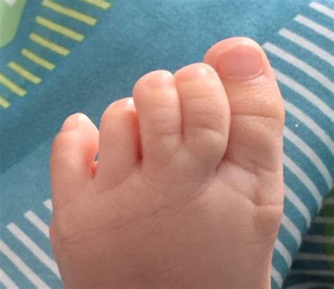 Does My Baby S Feet Looked Webbed To You Guys Babycenter