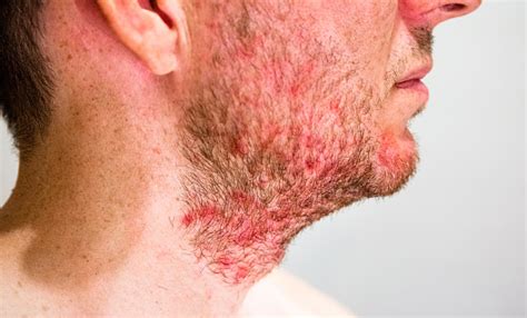 Man With Seborrheic Dermatitis In The Beard Area Stock Photo Download