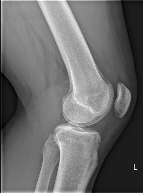 A Typical Sign On A Plain Knee Radiograph The Bmj
