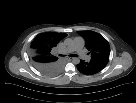Ct Scan Without Contrast Showing Right Pleural Effusion And Right Hilar