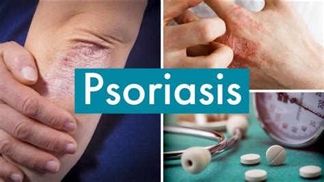 Psoriasis Causes Symptomes Complications Et Traitement Youtube