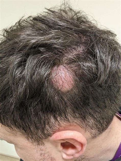 Cyst Removal From Scalp Solent Vascular Care
