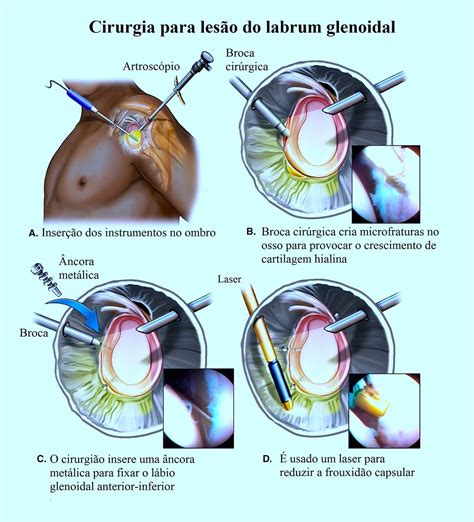 Instabilidade do ombro subluxação sintomas tratamento cirurgia