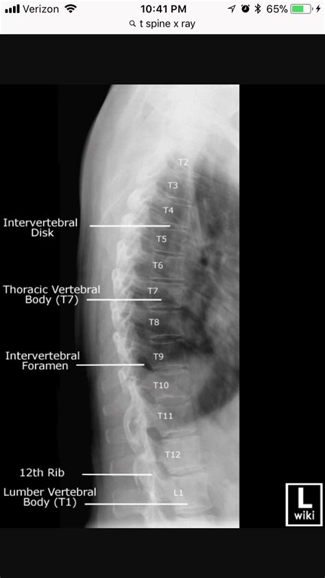 Lateral Thoracic Spine Xray Radiology Imaging Thoracic X Ray