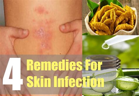 Skin Infection Treatment Skin Home Remedies Skin Herbs Natural