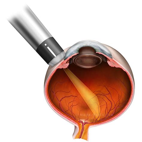 B Scan Ocular Ultrasound Probe With Transverse Beam