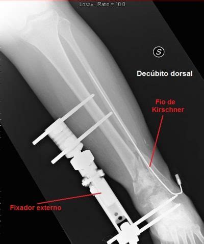 Fratura do maléolo da tíbia ou interno sem desvio reabilitação e