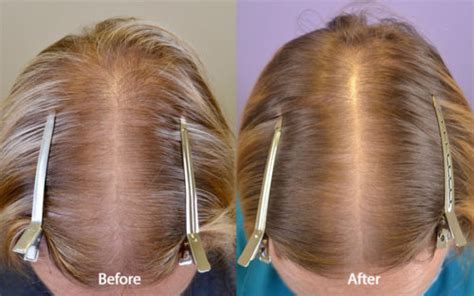 Spironolactone For Females Only Before And After Photos Hair