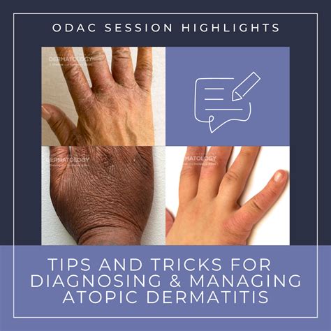 Tips And Tricks For Diagnosing And Managing Atopic Dermatitis Ad Next