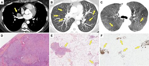 lung carcinoid tumors with diffuse idiopathic pulmonary neuroendocrine cell hyperplasia dipnech