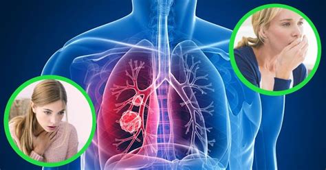 Lung cancer is usually very difficult to treat but, as with other types of cancer, catching it early will increase your chances of survival. Healthy Discuss: These Are The Early Signs Of Lung Cancer ...