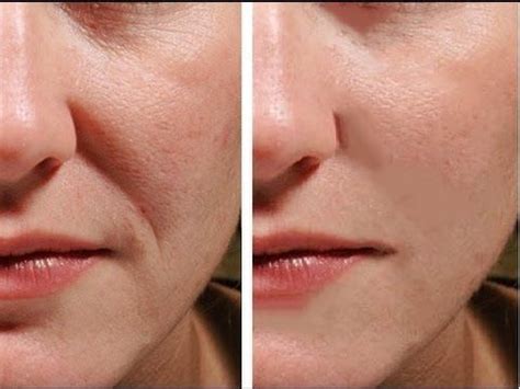 Avoiding smoking and eating a diet rich in fruit and vegetables are two lifestyle factors which can make a big difference. How To Remove Mouth Wrinkles In 3 Days - Lift Corners Of ...