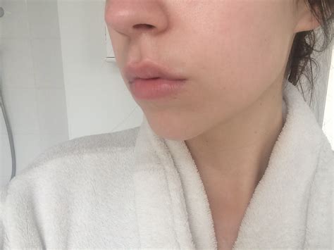 Lip Fillers With Flawless Cosmetic