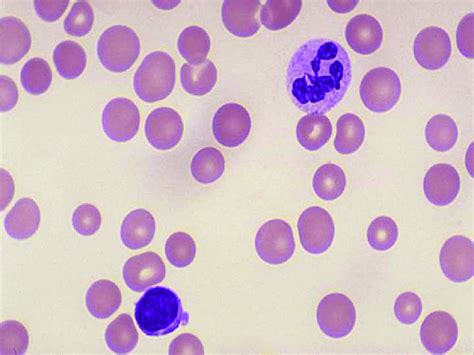 Peripheral Blood Smear Under 100 Â Magnification Showing Macrocytic