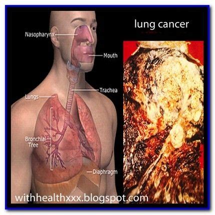 Lung cancer treatment in india: How Bad Is Stage 4 Lung Cancer - Cancer News Update