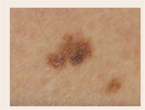 Figure From NON MELANOMA SKIN CANCER Skin Cancer Causes Risk Factors And Treatment
