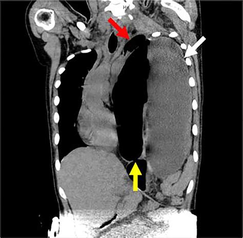 Maternal Diaphragmatic Hernia In Mid Pregnancy The Bmj