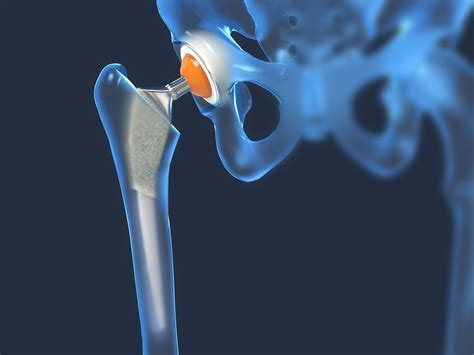 Superpath Vs Anterior Hip Replacement Which Is Better