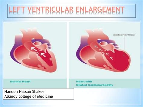 Left Ventricular Enlargement Radiology
