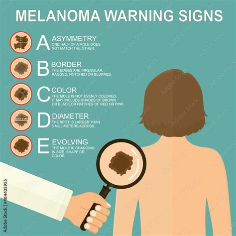 Melanoma Skin Cancer Warning Signs Abcde Diagnostic Assessment Hot
