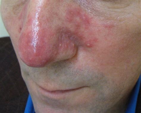 Rosacea Flushing Facial Redness And Pimples Société Canadienne De