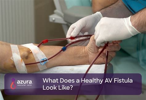 What Does A Healthy Av Fistula Look Like Azura Vascular Care