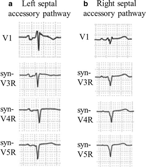 Right Sided Chest Lead Ecgs Lead V1 Syn V3r Syn V4r And Syn V5r Of