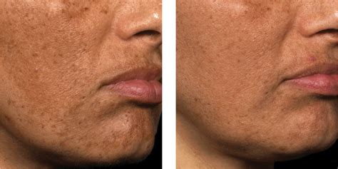 Fraxel Nyc Acne Scar Reduction Skin Care Tribeca Medspa