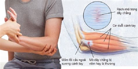 Bệnh viêm khớp khuỷu tay là gì Nguyên nhân triệu chứng và cách điều trị