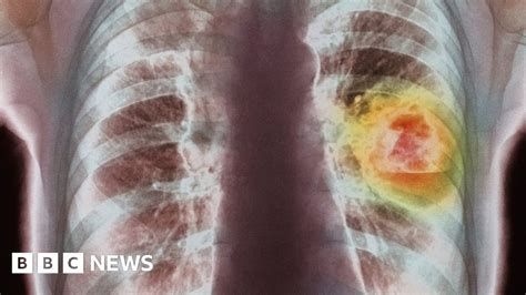 Lung Cancer Survivor First Symptom Was Shoulder Pain BBC News