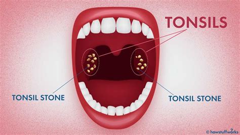 What In The World Are Tonsil Stones Howstuffworks