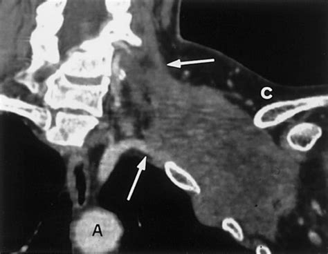 Chest Wall Tumors Radiologic Findings And Pathologic Correlation
