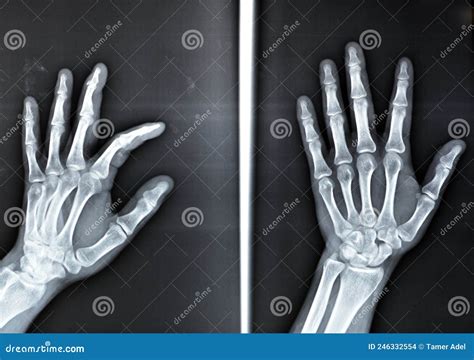 Plain X Ray Shows Avulsion Fracture Base Of The Distal Phalanx Of The Left Middle Finger