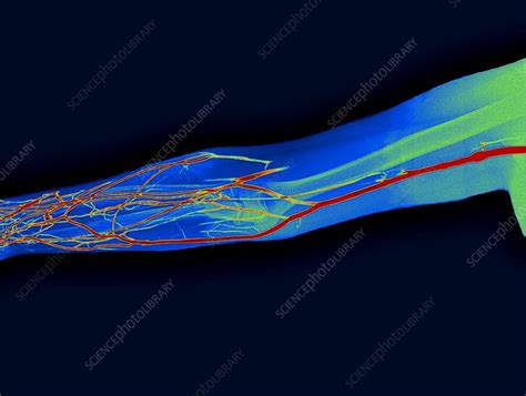 Arm Veins X Ray Stock Image C0017432 Science Photo Library