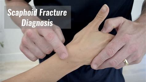 Scaphoid Fracture Diagnosis Anatomical Snuff Box Youtube
