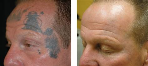 How Does Laser Tattoo Removal Work Collins Cosmetic Clinic