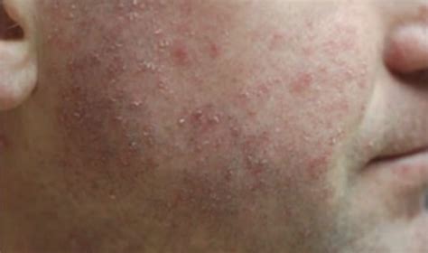 Amoxicillin Rash Symptoms Treatment Pictures Hubpages