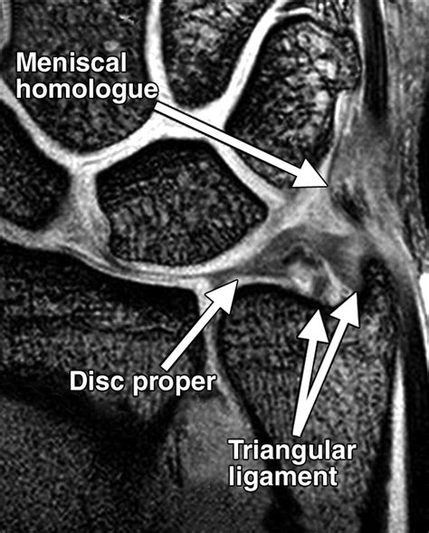 Pitfalls That May Mimic Injuries Of The Triangular Fibrocartilage And