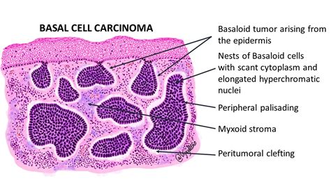 Basal Cell Carcinoma Pathology Made Simple